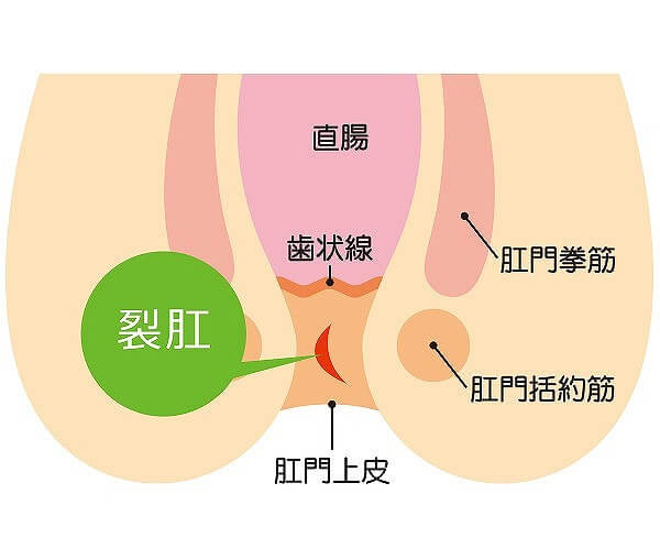 治し いぼ 方 痔