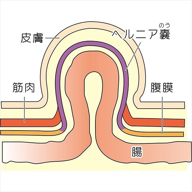 鼠径 部 の 黒ずみ