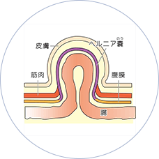 鼠径ヘルニア