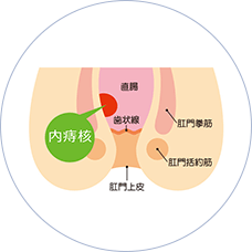 いぼ痔