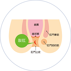 切れ痔