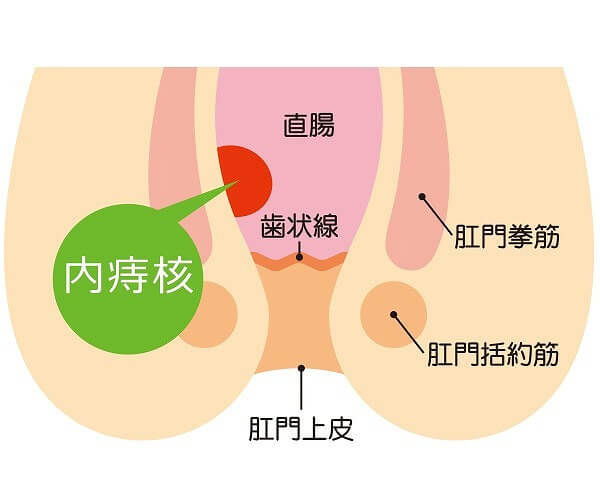 内痔核の主な症状