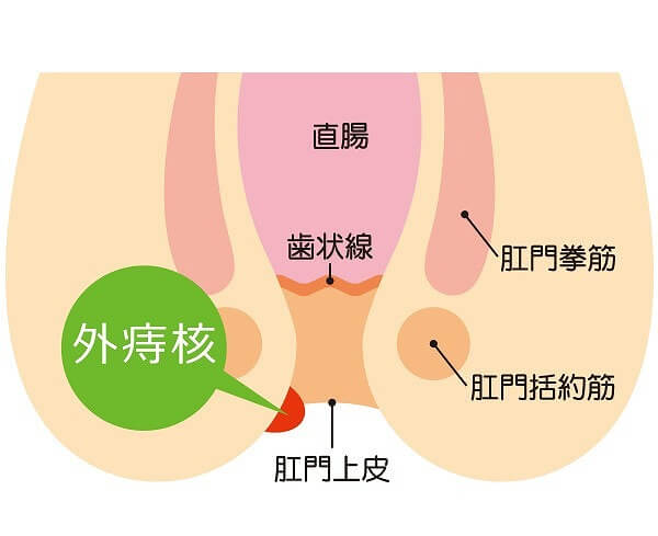 外痔核の主な症状