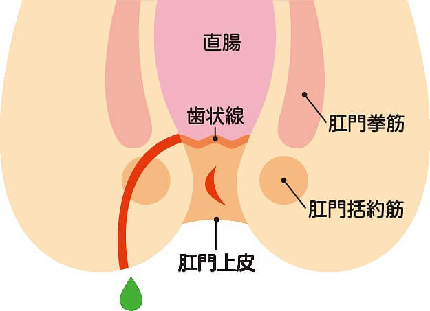 痔ろう(あな痔)とは